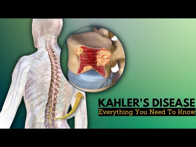 kahler-s-disease-causes-signs-and-symptoms-diagnosis-and-57-off