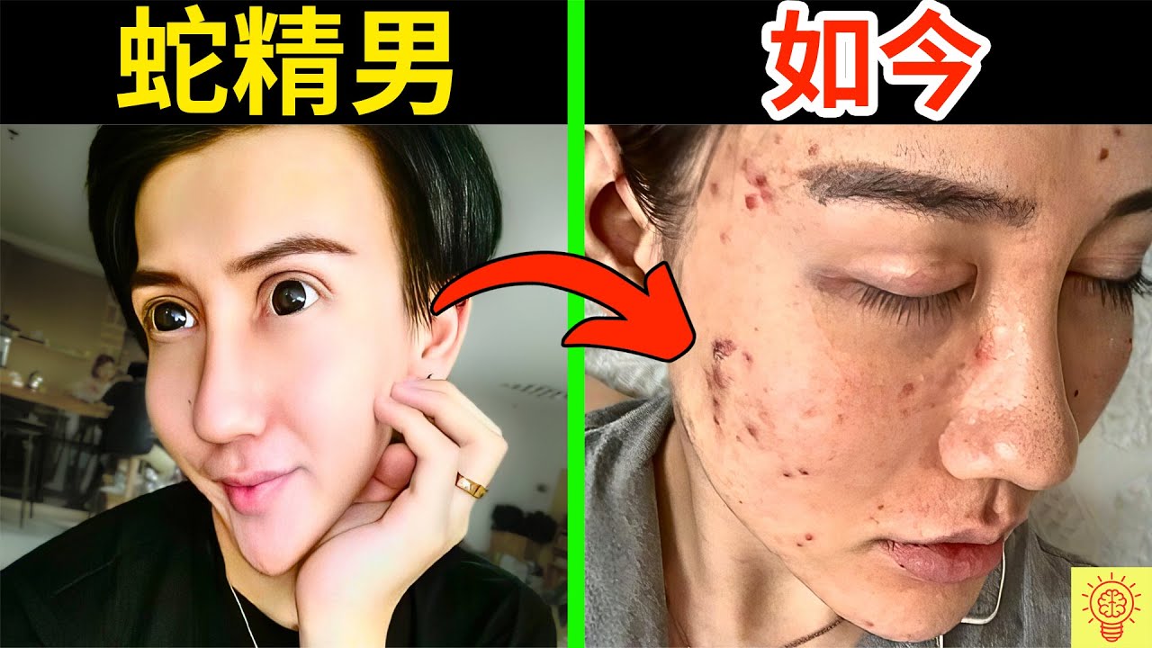 網紅【蛇精男】如今怎樣了？臉爛毀容、萬億流量歸零、被罵到停播！人設崩塌現場畫面曝光！