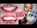 Blue Light Teeth Whitening Before And After