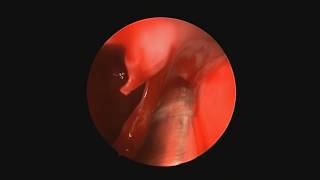 Severe posterior epistaxis - Endoscopic sphenopalatine branches ligation