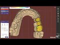 #exocad 3 reduced bridge