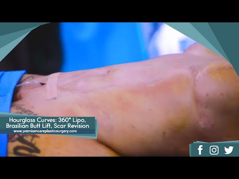 hourglass-curves:-360°-liposuction,-brazilian-butt-lift,-scar-revision