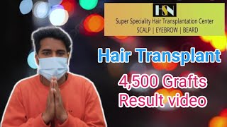 Awesome Hair transplant result reviewed by patient /  #hsn #beforeandafter #haircarespecialist