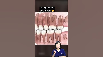 Răng khôn mọc thẳng có cần nhổ không | Dr Anh Thư