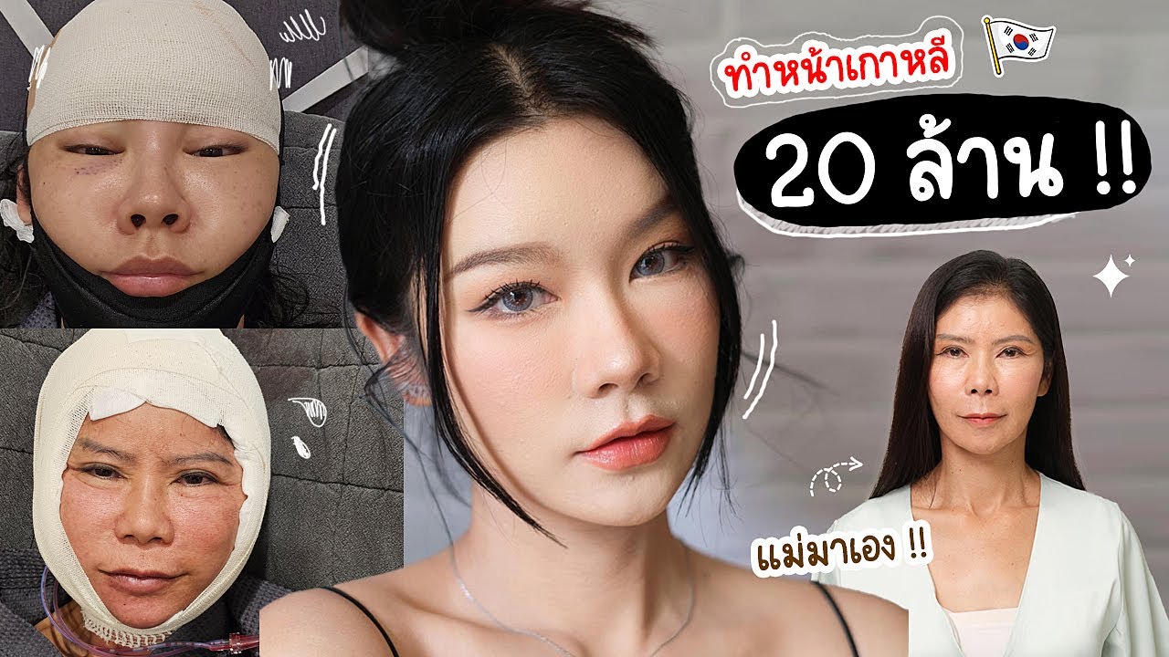 รีวิวทำหน้าสวยครบ1เดือน ผ่าตัดดึงหน้า | ทำเอนโดไทน์ยกคิ้วกับแม่ที่เกาหลี หน้านี้ใช้เงินเท่าไหร่