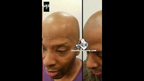 Amazing Before and After Scalp-Micropigmentation hair tattoo