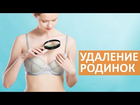 🔵 Удаление родинки. Методы удаления родинок | Семейный доктор