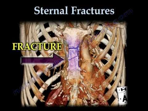 Sternal Fractures - Everything You Need To Know - Dr. Nabil Ebraheim