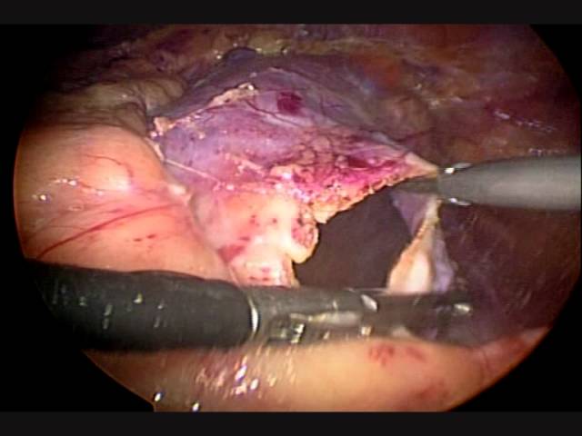 резекция кисты почки (deroofing) Аболмасов А.В.