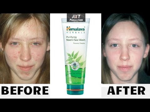 himalaya face wash for pimple marks