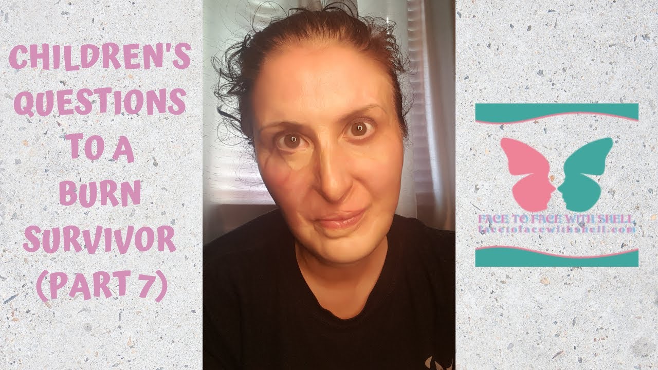 CHILDREN'S QUESTIONS TO A BURN SURVIVOR (PART 7) YouTube