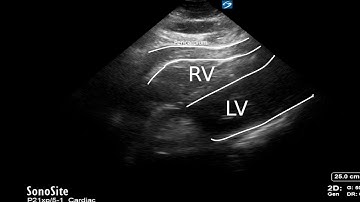 Case 1 cardiac arrest explanation