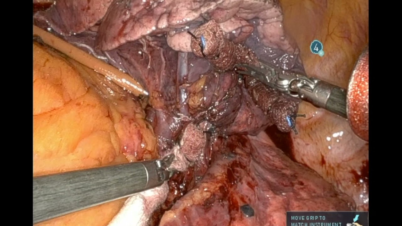 S4-5 Robotic Segmentectomy (LUL Lingulectomy)
