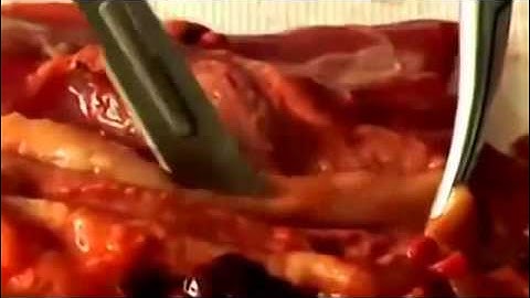 Độc tố tích tụ trong cơ thể người - Nguyên nhân chính gây ung thư & các bệnh thế kỷ