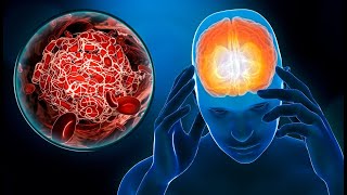 5 Common Foods That Can Trigger a Migraine Attack | What to Eat During Migraine