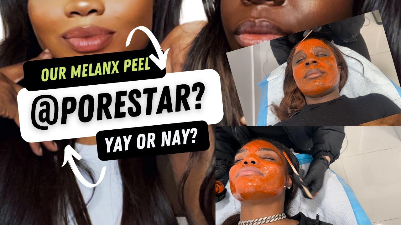 MELANX CHEMICAL PEELPORE STAR WHAT YOU NEED TO KNOW ABOUT THIS