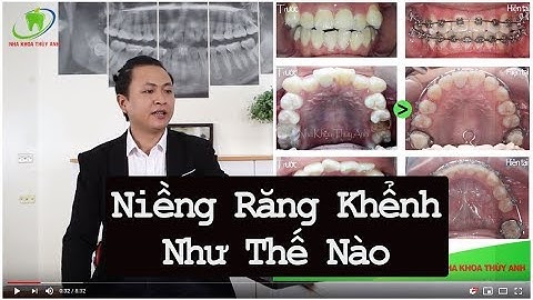 Niềng răng khểnh và lệch lạc thực hiện như thế nào?