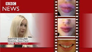 BBC NEWS: The Risks of Lip Fillers in Unsafe Hands