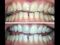 Oil pulling results. How to plus my before and after results