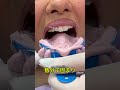 歯医者が入れ歯を作る方法‼️😱