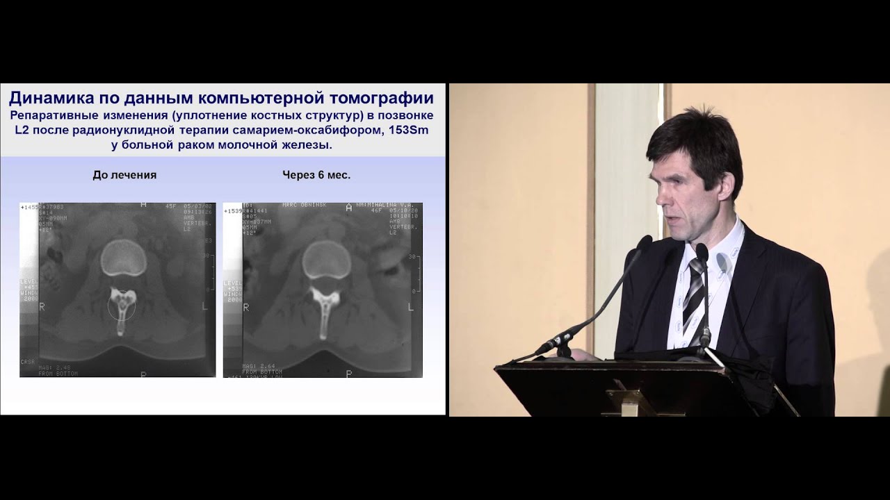 Эффективность радиофармацевтического лечения при метастазах в кости ...