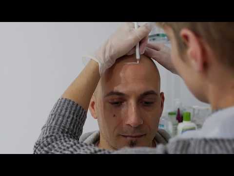 scalp-micropigmentation-|-hair-tattoo-|-smp-clinic-melbourne