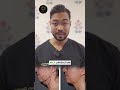 Do You Have a Double Chin? Causes and Advanced Treatment Options | Dr. Gautam Chaudhury In India