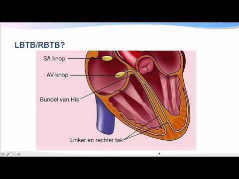 Video: Bundeltakblok - Compleet En Onvolledig (gedeeltelijk) Linker / Rechter Bundeltakblok