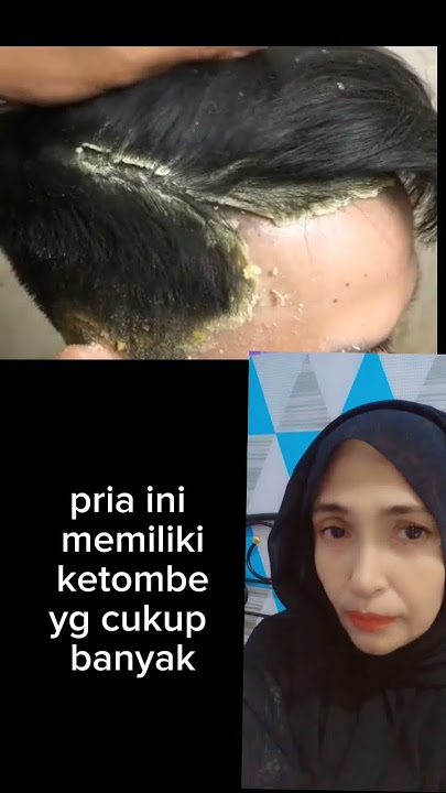 ketombe apa kerak telor??#shortsvideo