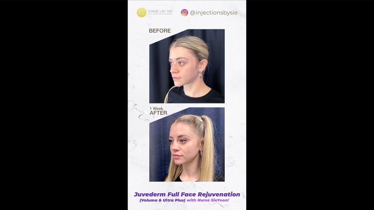 #JuvedermVoluma