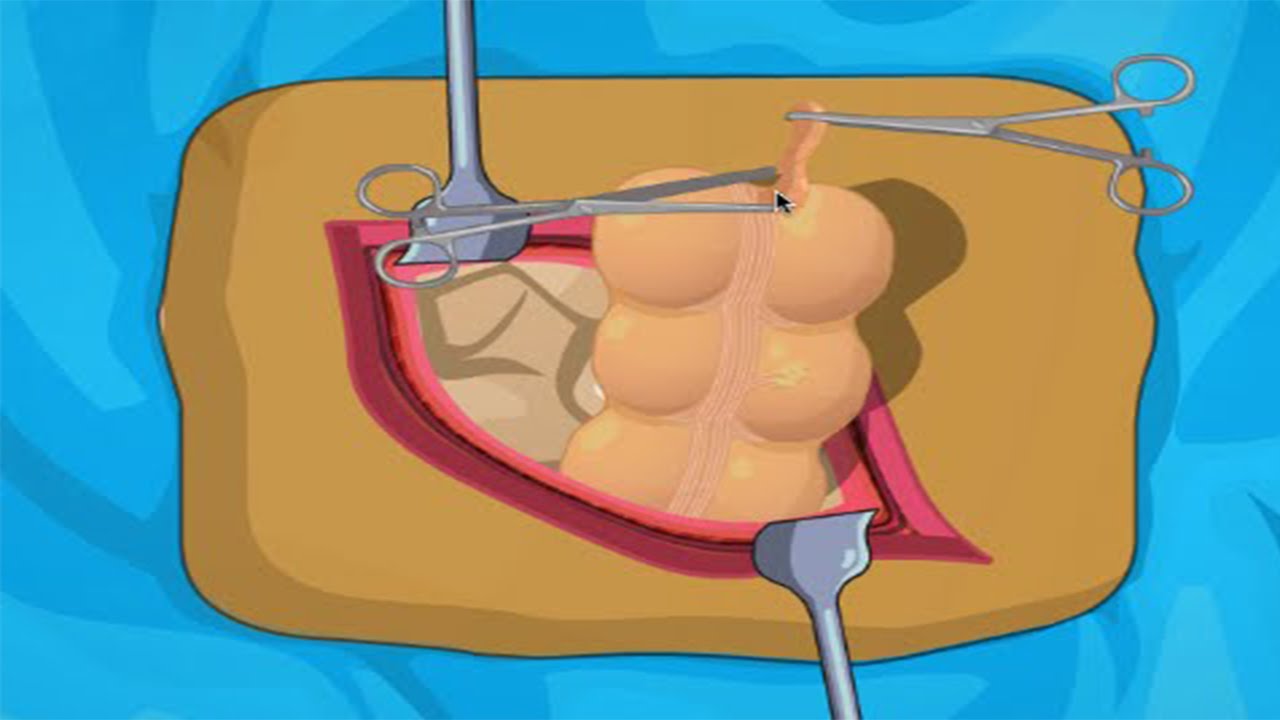 Doctorul Rancaciovean Appendix Surgery Youtube