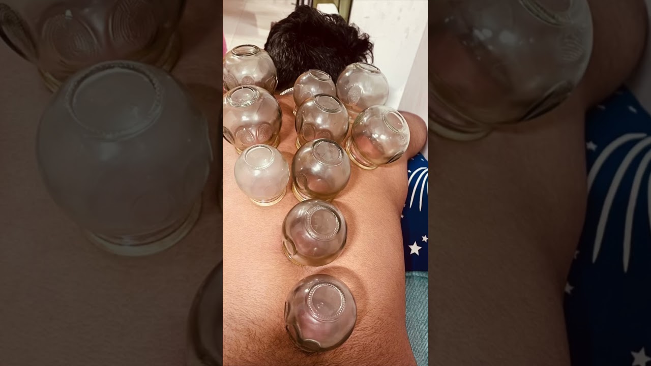 Fire cupping 