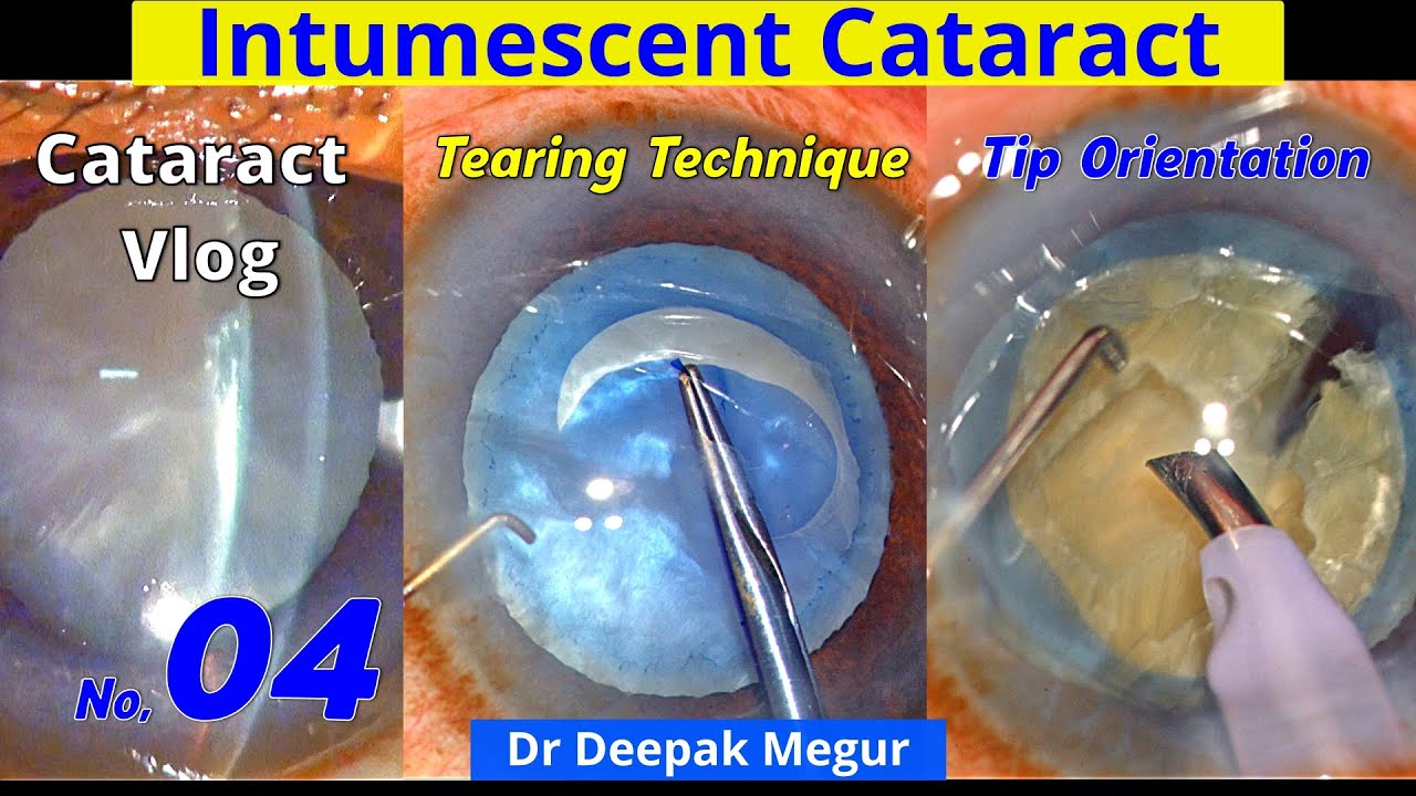 Cataract Vlog No,04 Tearing technique of Rhexis in Intumescent