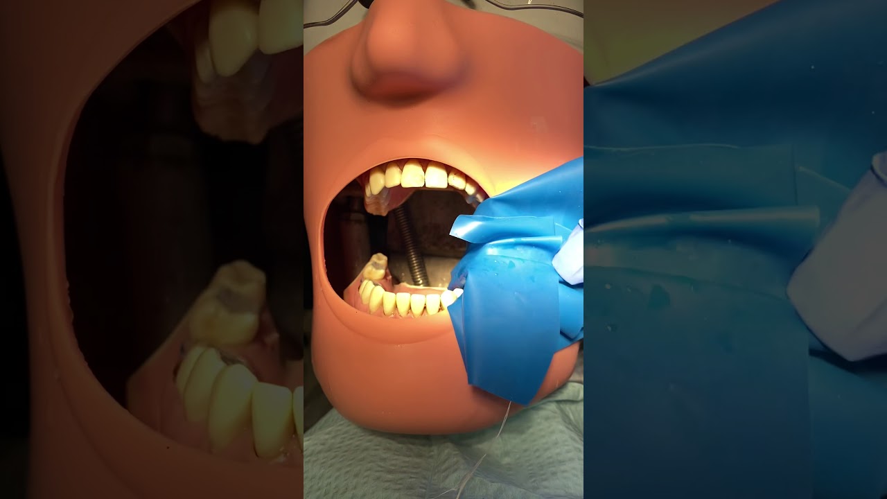 Root Canal Video: Chairside Assisting (Part II)