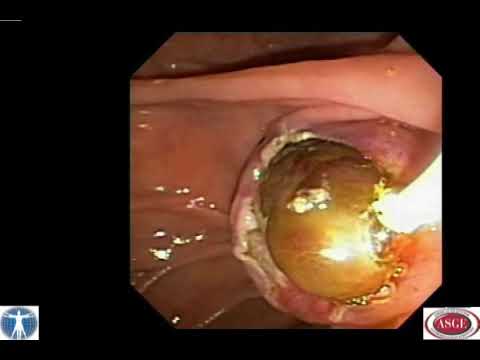 Endoscopic Resection of a Distal Bile Duct Mass