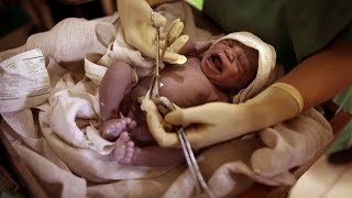 Tardar En Cortar El Cordon Umbilical Tiene Beneficios Para El Bebe Youtube