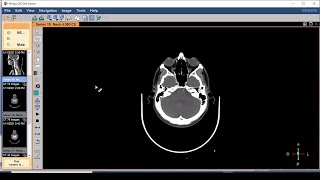 DICOM viewer software... the easiest way to review CTs and MRIs on your PC. screenshot 2