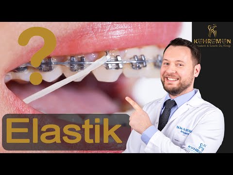 Ortodontik Lastikler Nasıl Takılır? (Sınıf II Elastik Kullanımı)