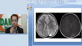 Radiology Spotters Part 7 Sturge Weber Syndrome