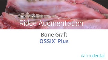 Ridge Augmentation - OSSIX® Plus & bone graft