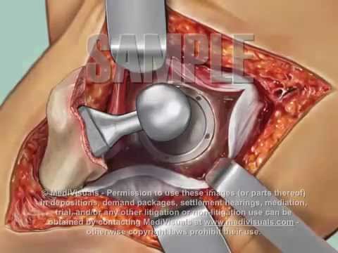 Video: Endoprotetik (ersättning) Av Höftleden