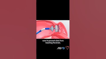 LAAC Procedure: Stroke Prevention in Atrial Fibrillation