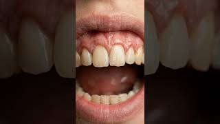 Plaque Build-Up Removal Satisfying Clean 🪥 – Thick tartar cleaned from teeth
