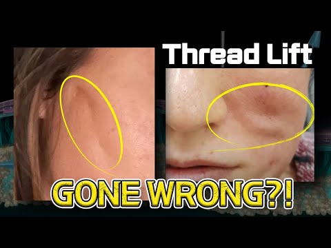 Thread Lift Gone Wrong? Watch This!