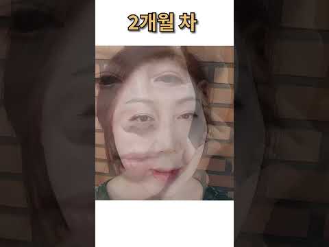 [전후영상] 절개리프팅 재수술, 눈썹밑절개, 눈, <strong>지방이식</strong> - 제이제이성형외과 #shorts