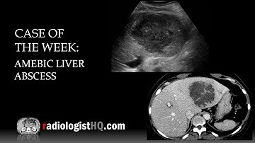 Case of the Week: Amebic Liver Abscess (Ultrasound & CT)