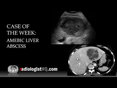 Case of the Week: Amebic Liver Abscess (Ultrasound & CT)
