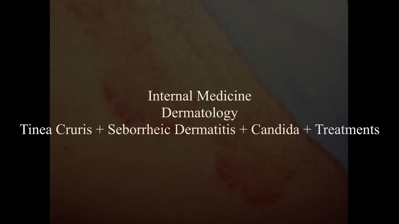 IM, Derm, Tinea Cruris (JockItch) + Seborrheic Dermatitis + Candida