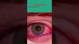Conjunctivitis | Eye Flu | Conjunctivitis symptoms | viral conjunctivitis | Hindi me