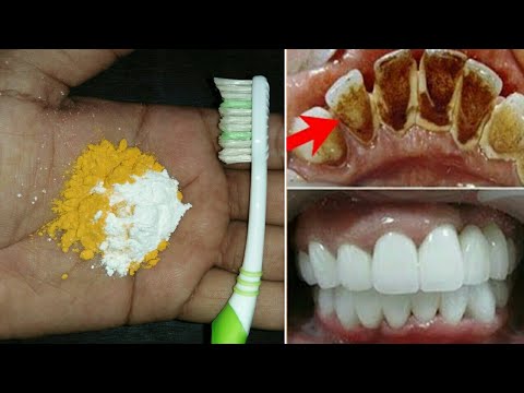 सिर्फ 2 मिनटों में पीले गंदे दांतों को मोती की तरह चमका देगा ये नुस्खा | White Teeth home remedy